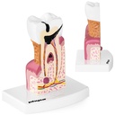 Anatomical model of a diseased human tooth in 6:1 scale