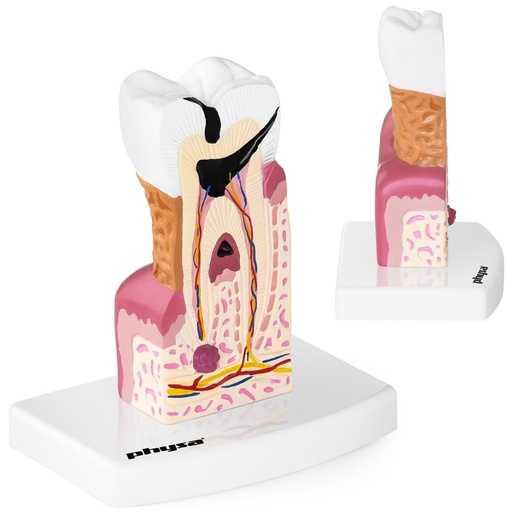 Anatomical model of a diseased human tooth in 6:1 scale