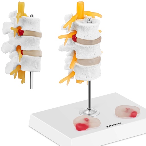 3D anatomical model of the lumbar spine with herniated vertebrae 3-5